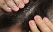 دلایل خشکی پوست سر؛ درمان و پیشگیری (مراحل درمان و انواع شامپو)