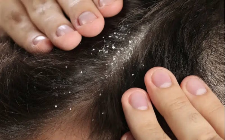 دلایل خشکی پوست سر؛ درمان و پیشگیری (مراحل درمان و انواع شامپو)